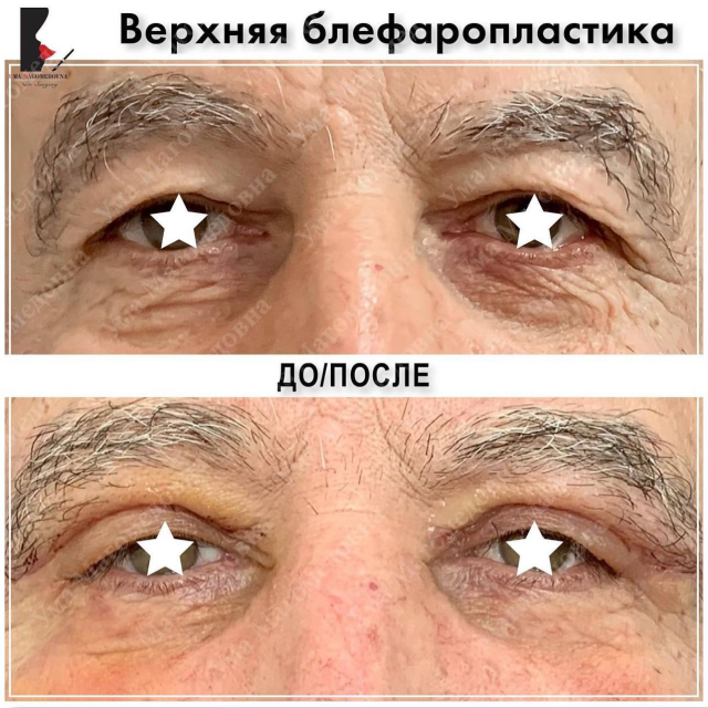 Верхняя блефаропластика