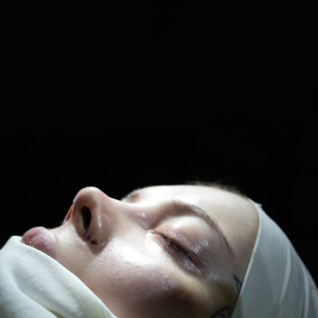 Ринопластика с ушиванием ноздрей