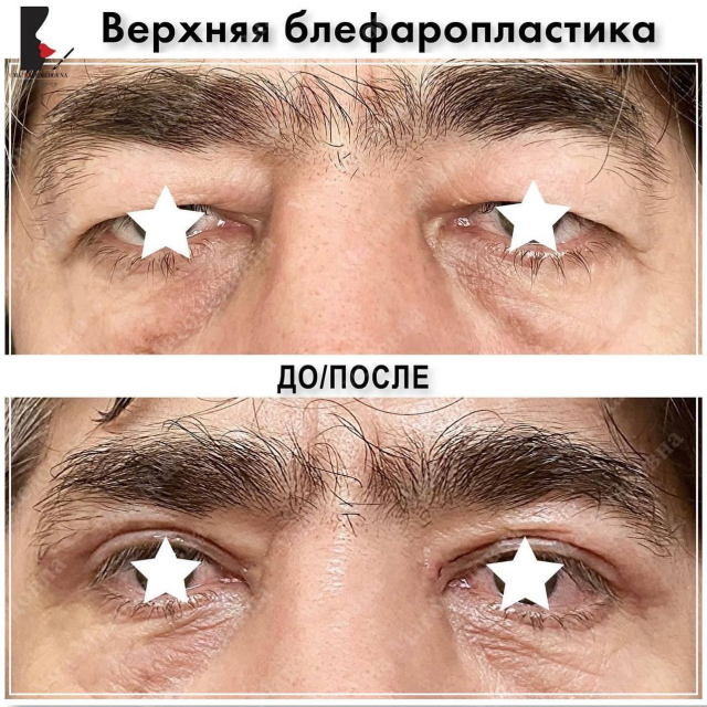 Верхняя блефаропластика