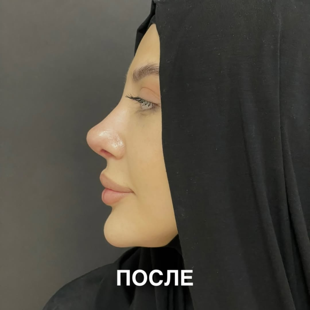 Риносептопластика