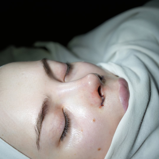 Ринопластика с ушиванием ноздрей