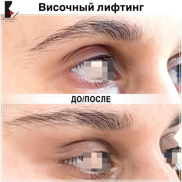 Височный лифтинг
