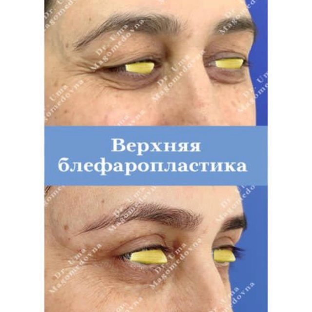 Верхняя блефаропластика