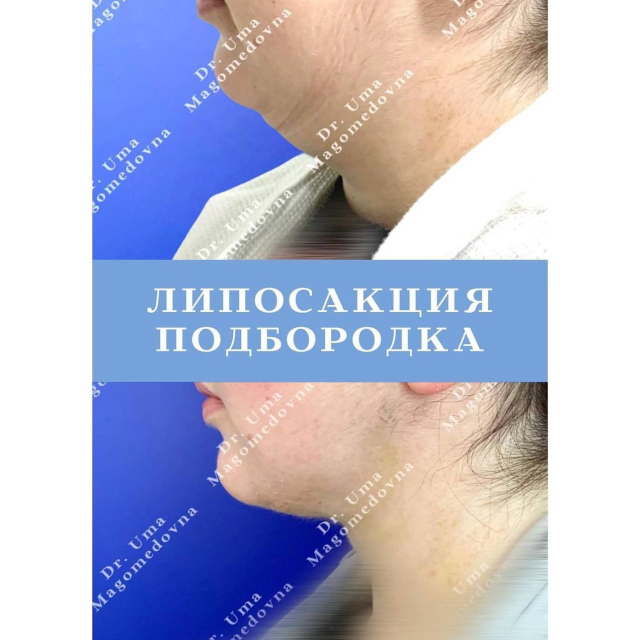 Липосакция подбородка