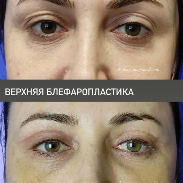 Верхняя блефаропластика