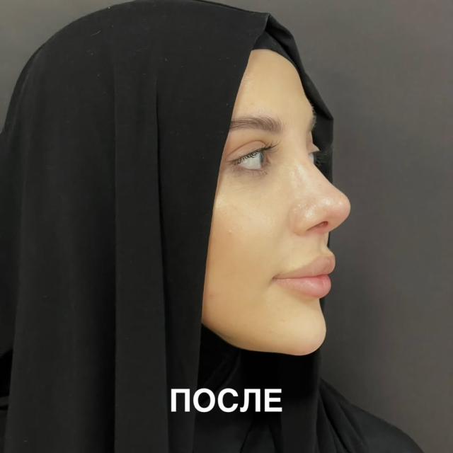 Риносептопластика