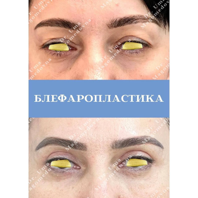 Блефаропластика