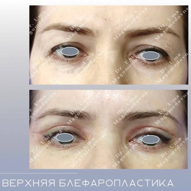 Верхняя блефаропластика