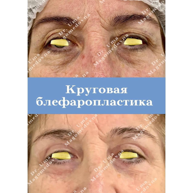 Круговая блефаропластика