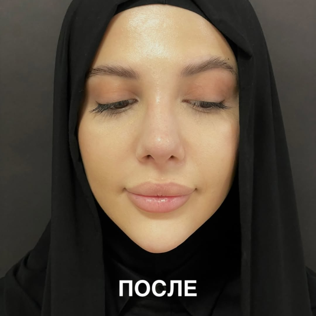 Риносептопластика