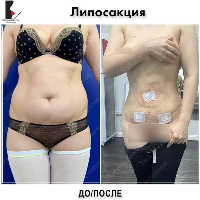Липосакция