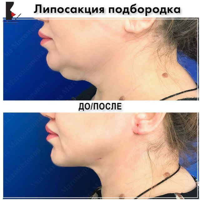 Липосакция подбродка