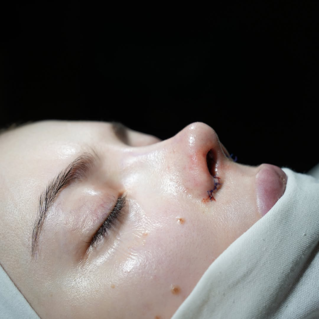 Ринопластика с ушиванием ноздрей