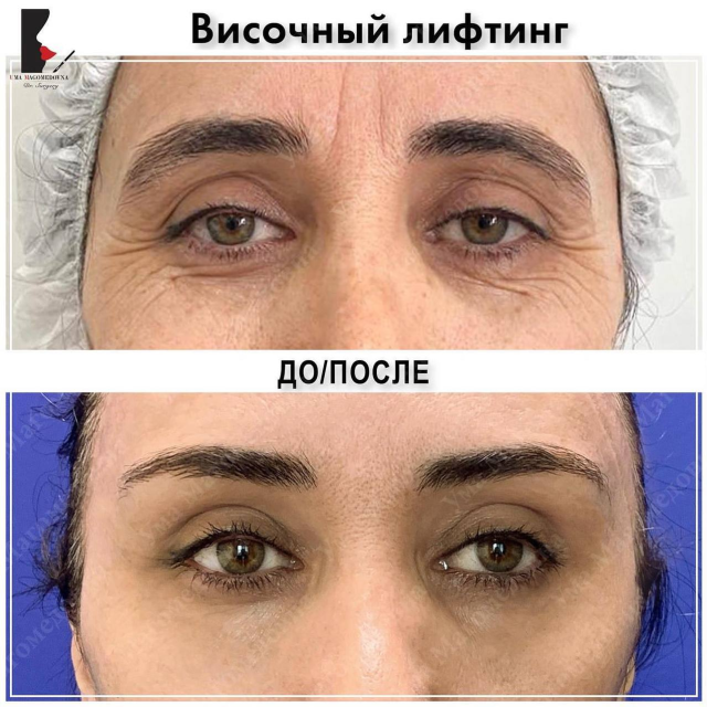 Височный лифтинг