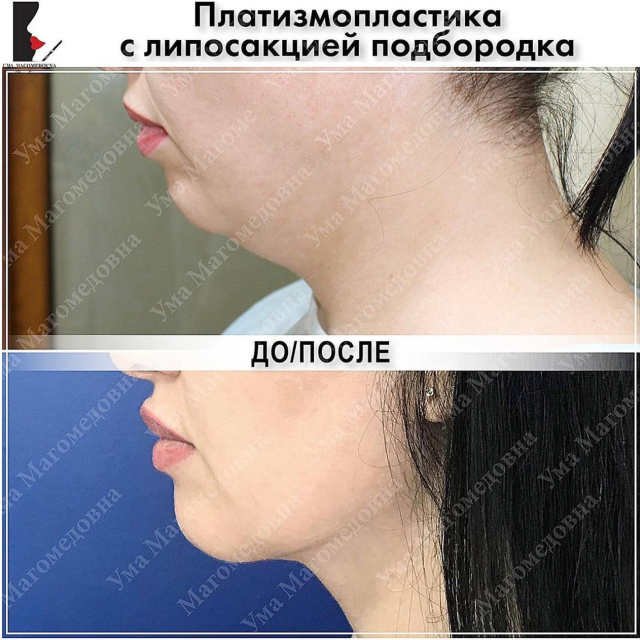 Платизмопластика