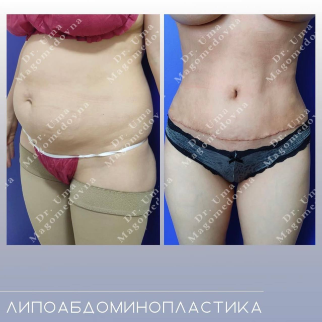 Липоабдоминопластика