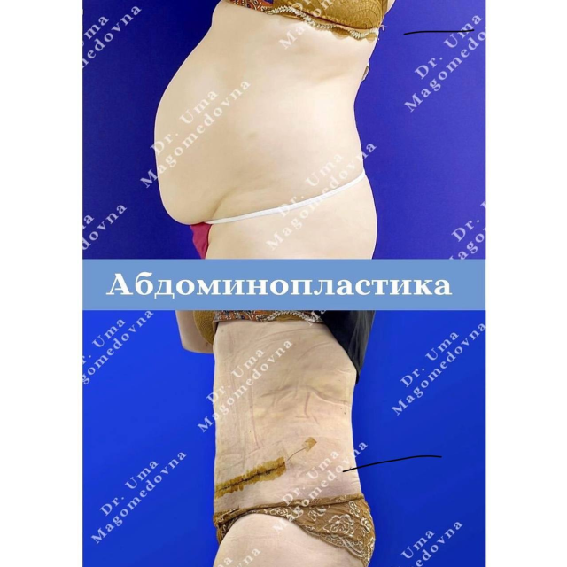 Абдоминопластика