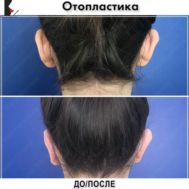 Отопластика