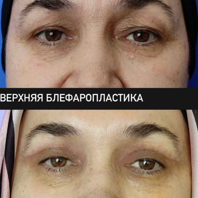 Верхняя блефаропластика