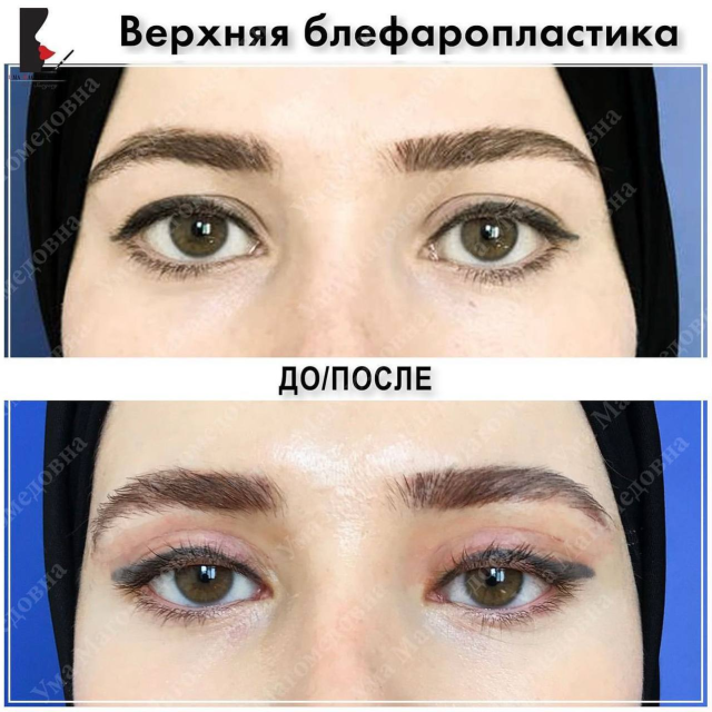 Верхняя блефаропластика