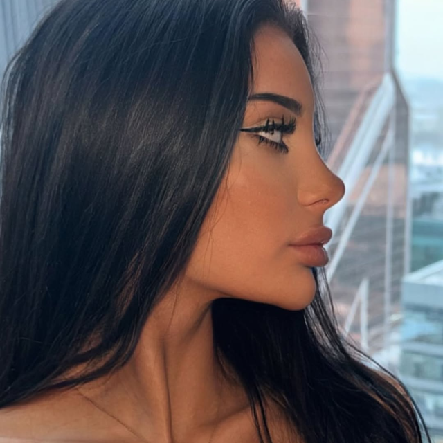 Ринопластика ✨ 8 месяцев после операции