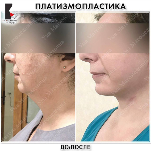 Платизмопластика