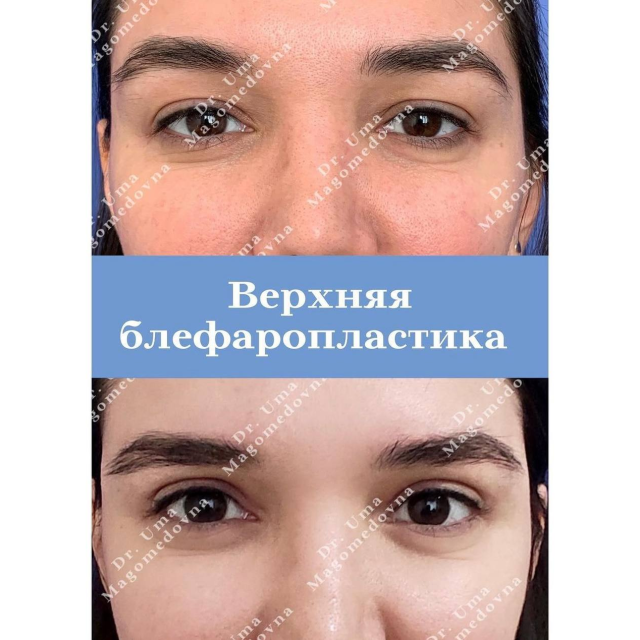 Верхняя блефаропластика