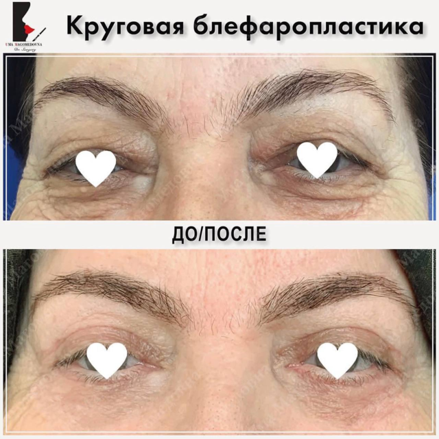 Круговая блефаропластика